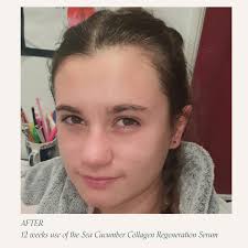 Hi Renee, last time we communicated was late April where I sent you some  photos of my daughter. I am now sending you her latest photo.....the  difference is amazing and it is