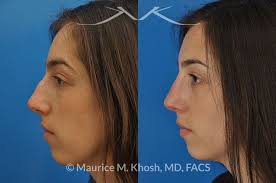 This is a before and after photo of nose job bump removal. Nyc Nose Hump Correction Surgery New York Dorsal Hump Rhinoplasty