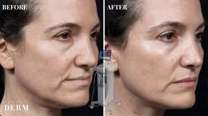 Thermage Benefits: Achieve Firmer, Younger Skin with Non-Invasive Treatment