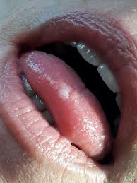 Image result for Puchýře na jazyku
