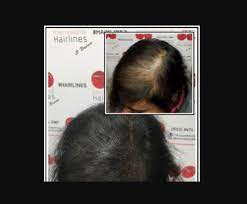 What Is The Best Treatment For Female Pattern Baldness
