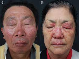 It helps to eliminate bumps and pimples that may appear. Microbiota In Rosacea Springerlink