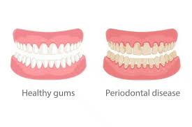 Image result for Gingivitis