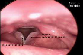 Image result for Reflux Laryngitis