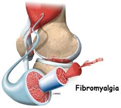 Clinical researches on the efficacy of spa therapy in fibromyalgia. Patient Education Concord Orthopaedics