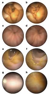 Image result for Virtual Endoscopy