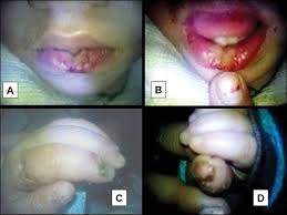 2014 1 17 Leschnyhan Our Dermatology Online Journal