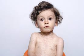 Image result for Measles