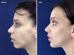 A longstanding insecurity had instantly disappeared. Chin Fillers Candidates Results Side Effects Cost And More