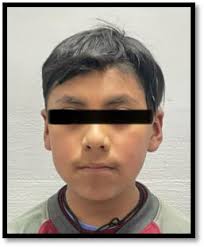 Caso inusual de incisivo lateral suplementario: una revisión detallada de  los dientes supernumerarios