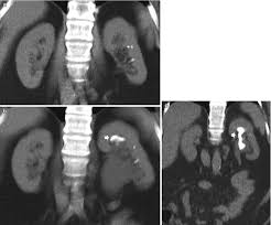 Image result for Nephrolithiasis Imaging