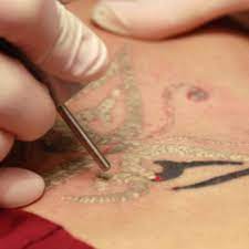 The fragmented particals are then naturally absorbed by your body fading the tattoo away to nothing. Tattoo Removal Reading Berkshire Chiltern Medical Clinics