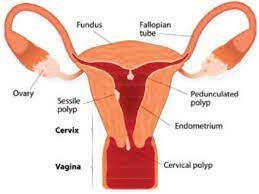 Endometrial polyps are overgrowths of endometrial glands that typically protrude into the uterine cavity. Endometrial Polyps Pathogenesis Sequelae And Treatment Abstract Europe Pmc