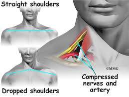 Pain in shoulder blade can be caused by overuse, wrong posture and many others. Thoracic Outlet Syndrome Eorthopod Com
