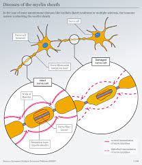 If the condition is severe, a patient is at risk for complications like pulmonary embolism and heart failure. Guillain Barre Syndrome A Sudden Paralysis Of The Arms And Legs Science In Depth Reporting On Science And Technology Dw 13 07 2021