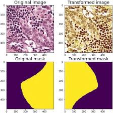 Biphasic malignant mesothelioma is characterized by the coexistence of epithelial and sarcomatous types. Pathml A Unified Framework For Whole Slide Image Analysis With Deep Learning Medrxiv