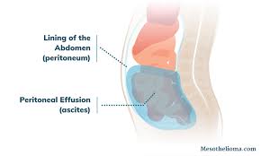 Image result for Ascites