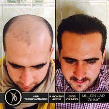 Million Hair Center Sac Ekim Merkezi