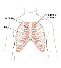 Pain in the uppper tommy right under the ster. What Is Costochondritis Unusual Symptoms And Self Help Tips For Agonising Chest Pain Welsh Mummy Blogs