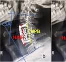 Risk factors for subsidence of titanium mesh cage following ...