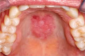 Image result for mouth ulcer on tongue)