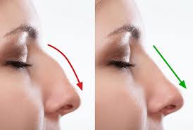 A fost operatie pt deviatia de sept? Recuperare DupÄƒ Rinoplastie Soma Clinic