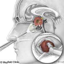 Maybe you would like to learn more about one of these? Tingkat Keberhasilan Operasi Tumor Otak Tnc