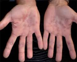 38 top pictures syphilis ab wann nachweisbar : Syphilis Lues