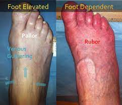 Clinical Evaluation Of The Foot For Peripheral Arterial Disease | Michael  Cumming, Md, Mba