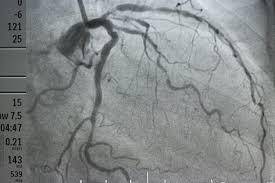 The same lifestyle habits used to help treat coronary artery disease can also help prevent it. Signs You May Have Clogged Arteries Best Health Canada