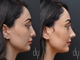 Beverly Hills Rhinoplasty Specialist Dr Donald Yoo Performed A Revision Rhinoplasty With Ear Cartilage On A Rhinoplasty Nose Surgery Rhinoplasty Nose Surgery