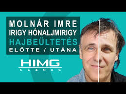 Irigy Hónaljmirigy: Molnár Imre Hajbeültetése