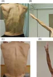 Find out how to fix it here! Winged Scapula Following Axillary Thoracotomy With Long Thoracic Nerve Preservation Bmj Case Reports