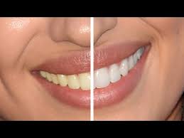 Here's a quick summary of the steps for how to whiten teeth in photoshop: Photoshop Cc Tutorial How To Whiten Teeth Quick Tip For Beginners Youtube