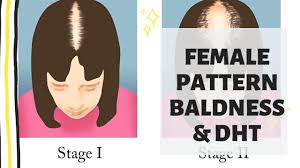 This is a risky subject and women usually try to avoid it. Female Pattern Baldness Dht Hair Loss How To Treat Youtube