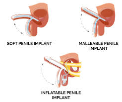 Image result for Penile Prosthesis