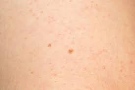 Tiny red spots on skin will often be accompanied by other symptoms such as itching, pain. What Do Red Spots On Skin Mean 13 Skin Spots Bumps Pictures
