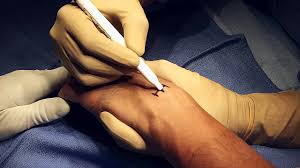 How long does it take for a ganglion cyst to go away? Ganglion Cysts What Is Symptoms Causes Treatment The Hand Society