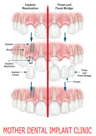 Dental Implants Vs Fixed Bridge Dental Implant Procedure In Delhi Dental Implant Clinic In Delhi Dental Implant Procedure Tooth Implant Cost Dental