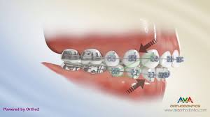 How to use braces and forsus to treat an overjet, often referred to as an 'overbite'. Rubber Bands Ava Orthodontics Invisalign