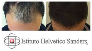 Nel metodo del trapianto di capelli senza rasatura, la regione della nuca tra le due orecchie viene rasata, che designiamo come la regione donatrice in cui . I Risultati Di Luca Con Il Trapianto Capelli F U E Effettuato Tramite Istituto Helvetico Sanders Catanzaroinforma