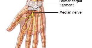 Carpal Tunnel Syndrome Explained Carpal Tunnel Syndrome Carpal Tunnel Median Nerve
