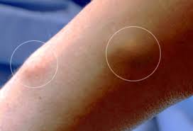 Arm lump information including symptoms, diagnosis, treatment, causes, videos, forums, and local community support. Pictures Of Bumps On Skin Cysts Skin Tags Lumps And More