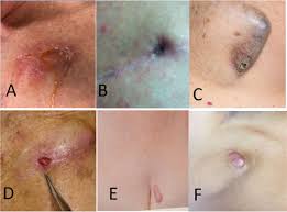 Image result for Cardiac Pacemaker Infection