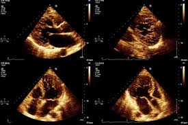 Image result for Left Ventricular Noncompaction