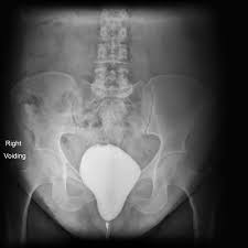 Image result for Voiding Cystourethrogram