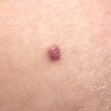 Carrie madormo, rn, mph, is a freelance health writer with over a decade of experience working as a reg. Should I Be Concerned About My Mole Turned Into A Blood Blister Photo