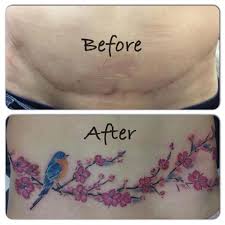 When Can You Have A Tummy Tuck After C Section Pin On Common Problem Of Tattoo Artist