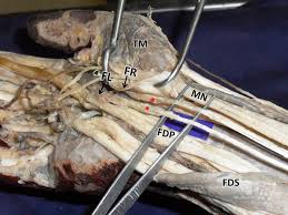 Click to see full answer Dissection Of Flexor Compartment Of The Right Forearm And Palm Showing Download Scientific Diagram