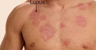 12 Early Symptoms And Signs You Have Lupus Healthandconditons Lupus Symptoms Body Rash Lupus Rash